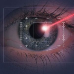 chirurgia-laser-miopia